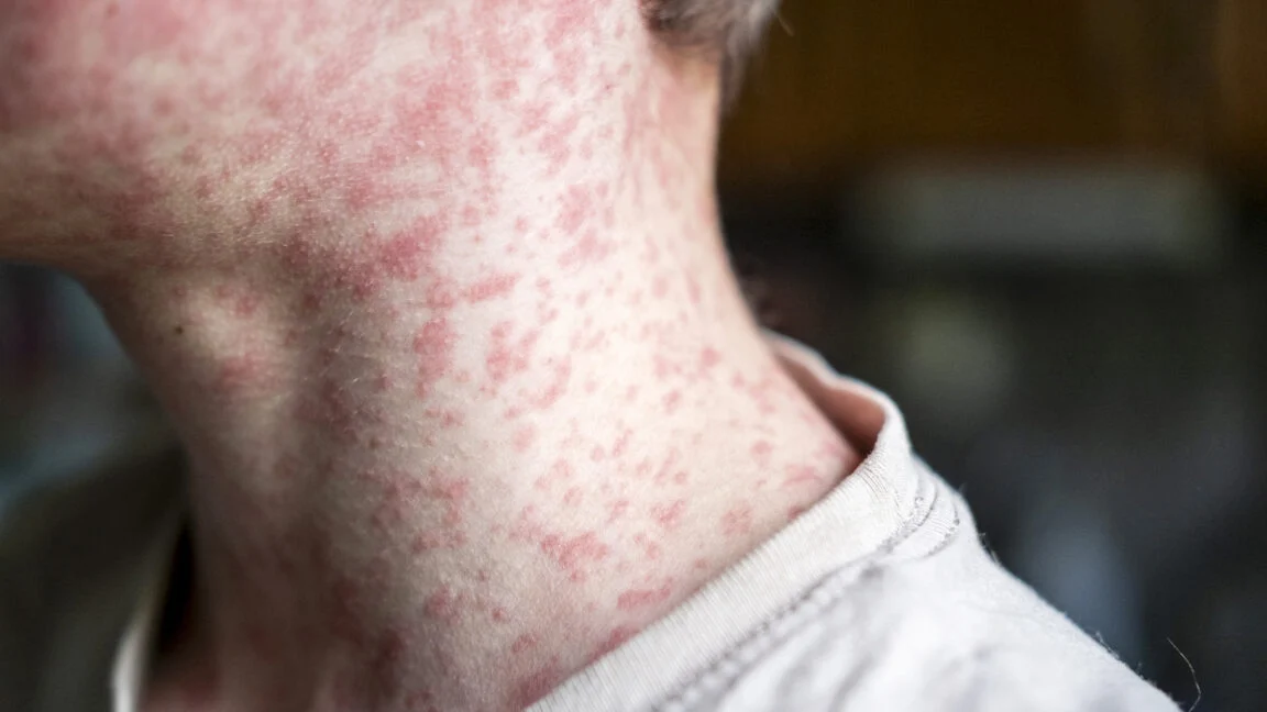 Pennsylvania Reports Fourth Measles Death as US Outbreak Becomes Deadliest in Decades